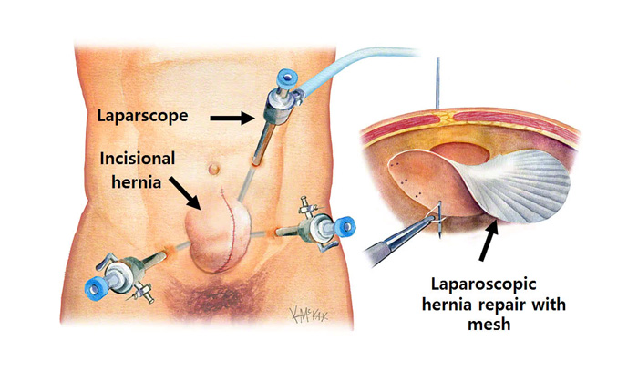 Incisional Hernia Repair-Get Best Treatment by Freedom From Obesity