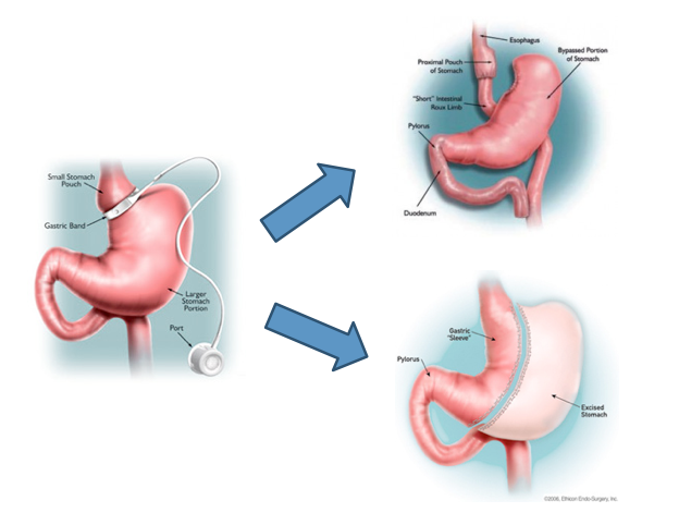 What is Bariatric Revision Surgery